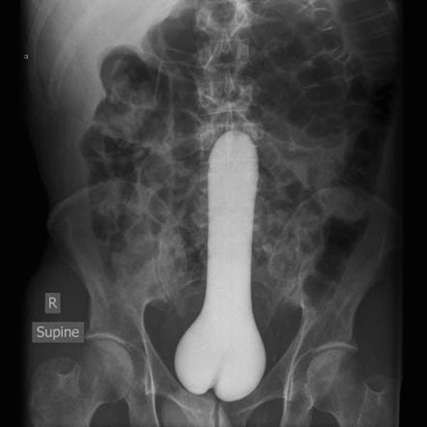 Website Compiles X-Ray Photos Of Weird Things Stuck Up People's Butts Website Compiles X-Ray Photos Of Weird Things Stuck Up People's Butts