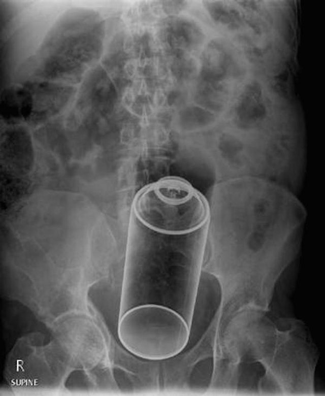 Website Compiles X Ray Photos Of Weird Things Stuck Up Peoples Butts 