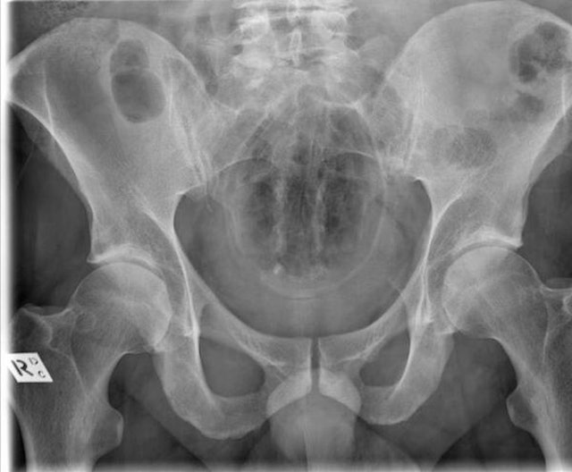 Website Compiles X Ray Photos Of Weird Things Stuck Up People S Butts