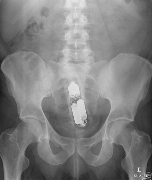 Website Compiles X Ray Photos Of Weird Things Stuck Up Peoples Butts