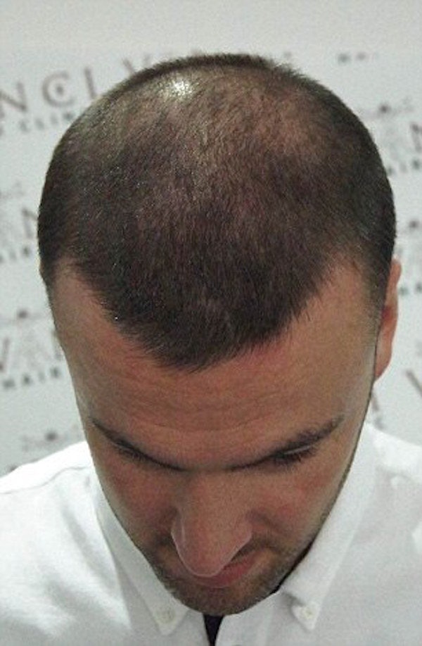 Hair Tattoo For Bald Men / Head Tattoos Tattoo Insider fastestlose