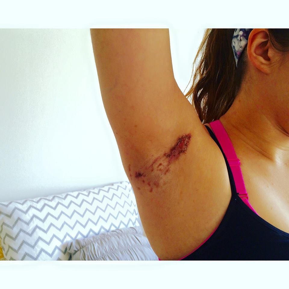 People Claim This Popular Deodorant Is Leaving The Most Insane Burns