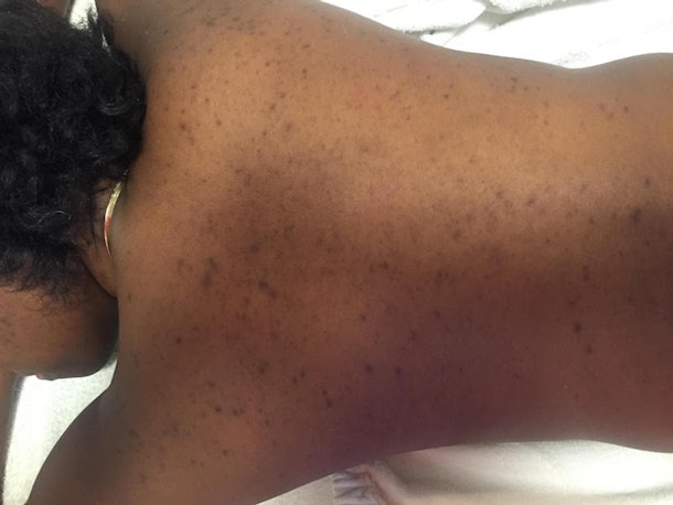 This Chemical Peel Will Get Rid Of Your Bacne Scars In Time For