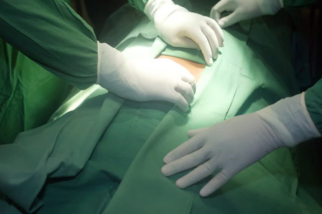 How Long To Recover From Appendix Surgery