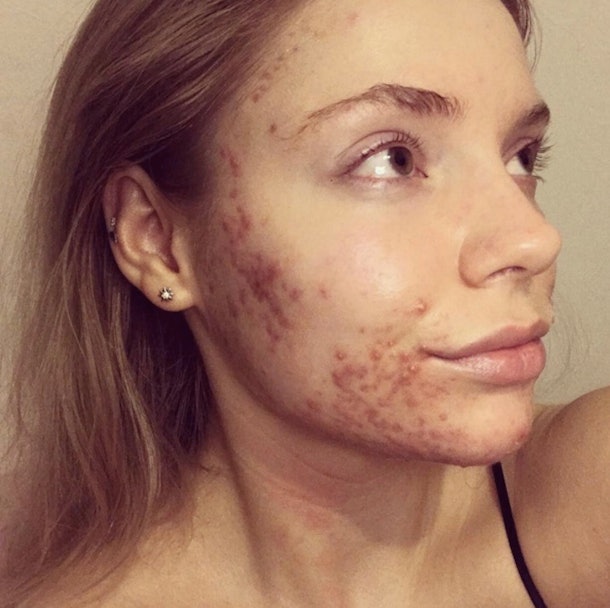 Beauty Pageant Finalist Credits Diet Trick To Get Rid Of Acne - 610 x 608 jpeg 64kB