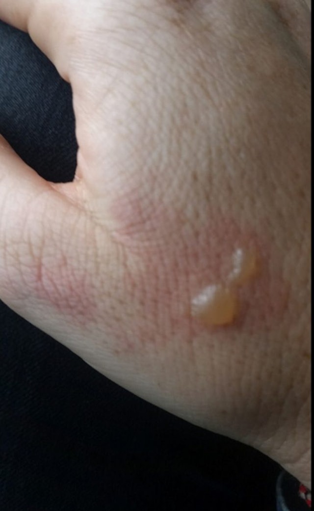 Woman's Headphones Explode In Her Ears On Airplane