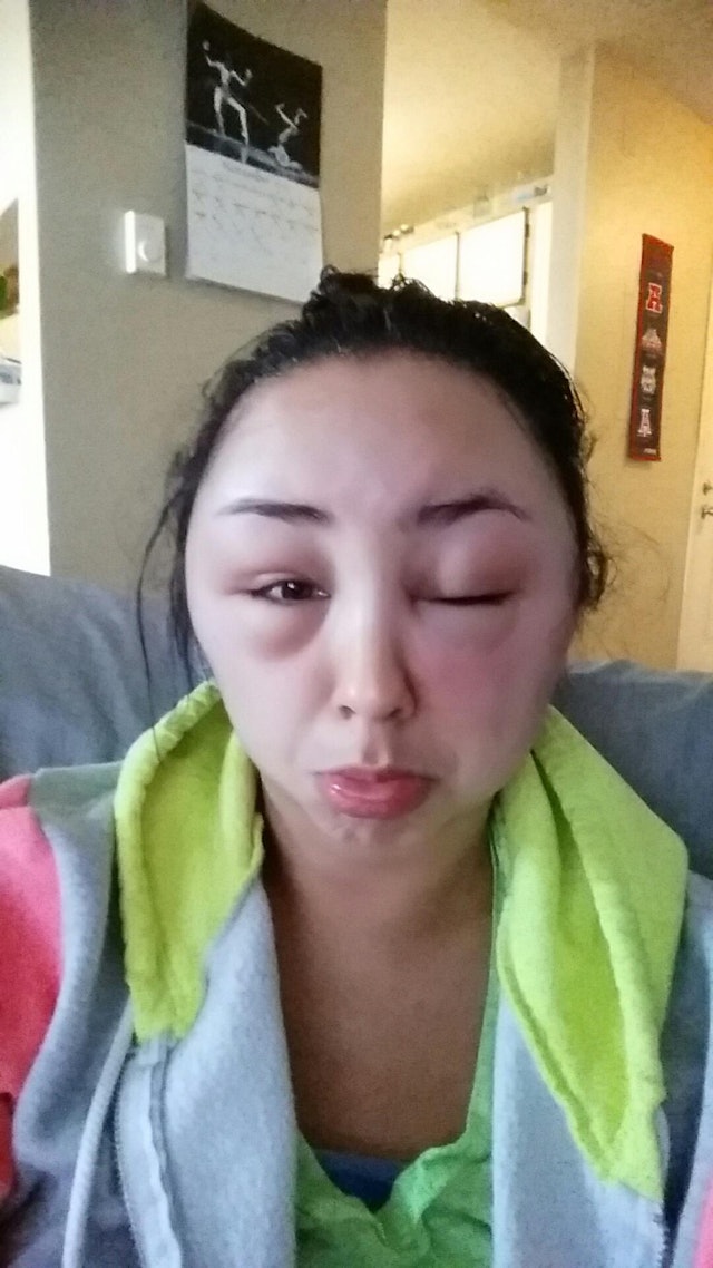 This Woman Had The Most Insane Allergic Reaction To Her Hair Dye (Photos)